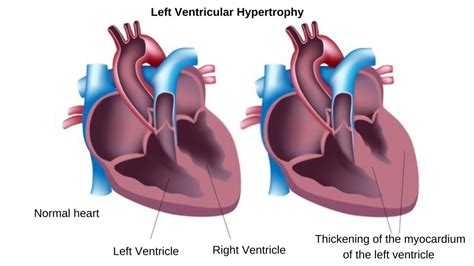 lv overload symptoms|lv hypertrophy management.